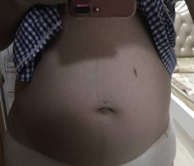 肚型看男女_孕25周多,身高170,体重长了16斤,