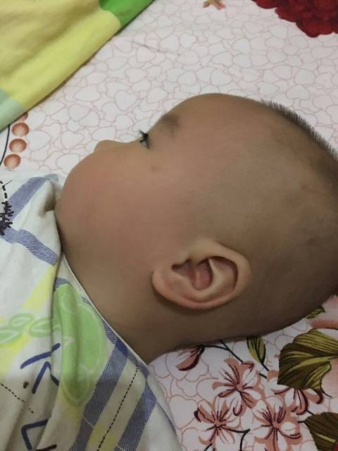 宝宝过敏后多久可以打防疫针?