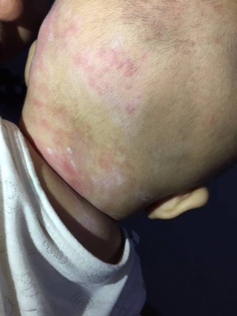 宝宝到底是湿疹还是荨麻疹?_前面三张是今天