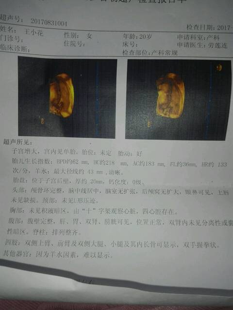 怀孕22周做的四维彩超_帮忙看看是男孩还是女