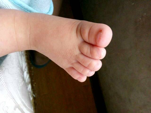 宝宝两个脚的第二个脚趾都有点歪,正常吗?急求