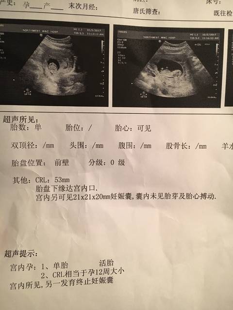 双变单,一个宝宝发育太好_怀孕45天b超显示双