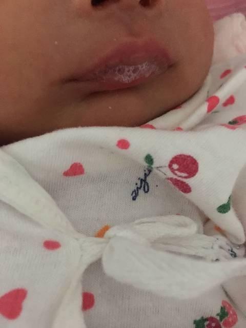 宝宝嘴里吐沫沫 脸上有痘痘是湿疹吗_宝宝26天