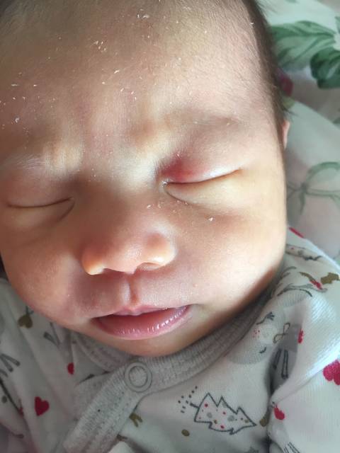 宝宝眼皮有红块,怎么办?_出生就有,已经20天了