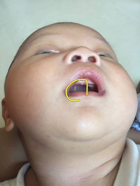 一个多月宝宝上颚有白点