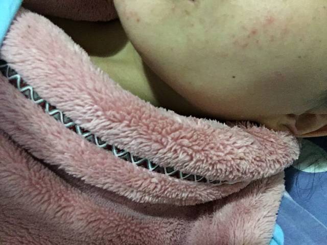 有宝妈孕期脸上长类似痱子样的疙瘩的吗?_孕