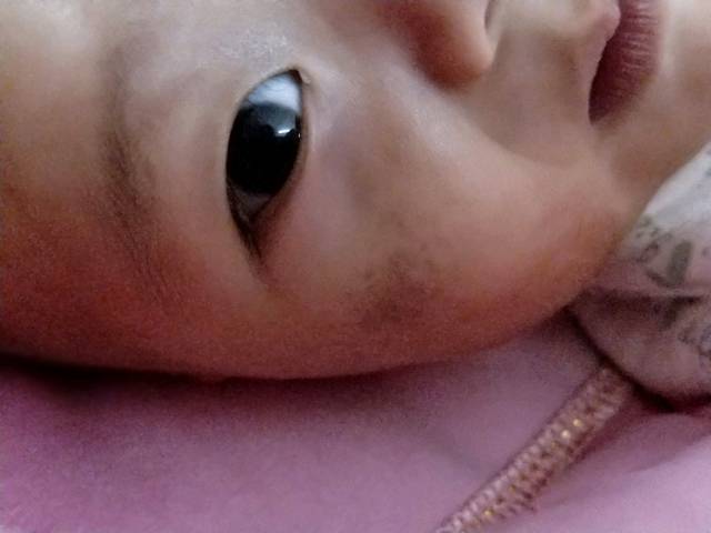 太田痣_我家宝宝四个月时长出淤青一块以为没