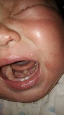 各位宝妈,我家宝宝舌头底下长了一个小舌头,怎麼回事啊?