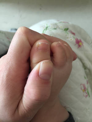 宝宝一岁,发现脚指甲有竖著的一条纹.各位宝妈有遇到过吗?