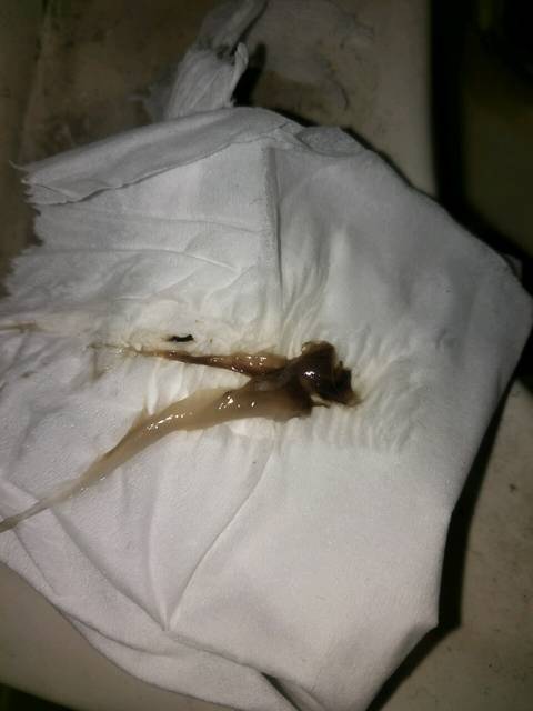 怀孕初期褐色果冻状分泌物