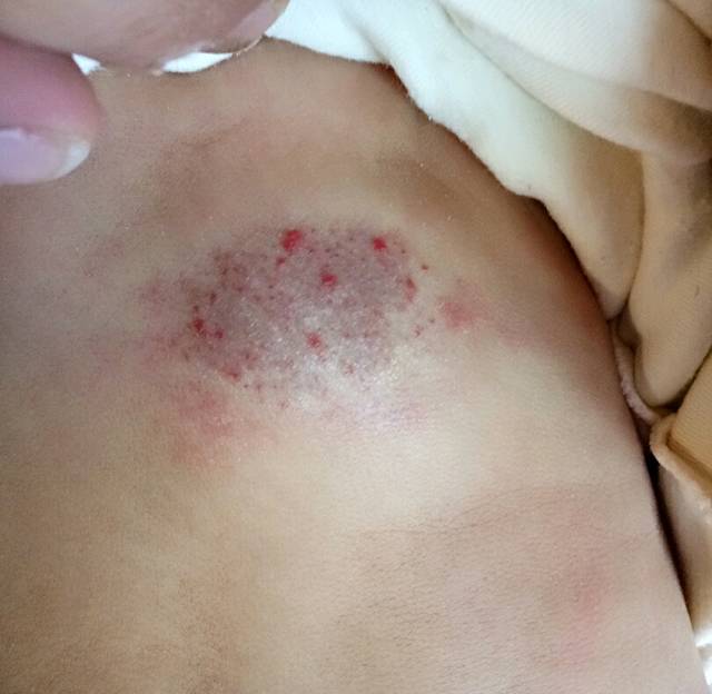 血管瘤治疗_我家宝宝两个月 背上有血管瘤 目前还没有