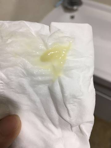 怀孕6周白带这样 正常麽? 没有异味也不痒