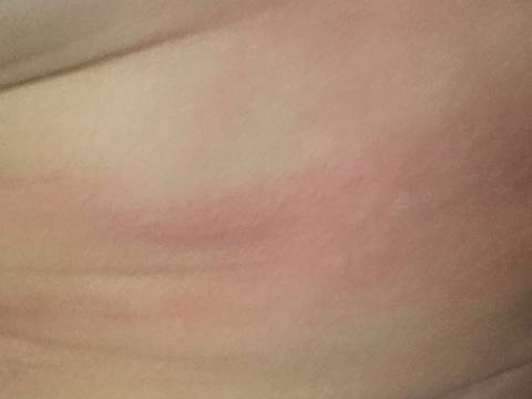 孩15个月,今天下午突然手膀子上起红疹,很痒。