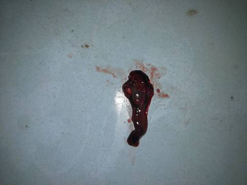 我孕6周多的时候大出血。到今天孕7周了我排出了这个。好心疼,不知道是不是我宝B