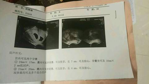 2月14号孕六周+3阴超两个胚胎,一个胎芽7mm