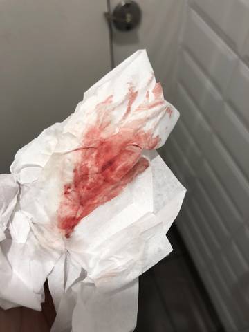 剖腹产后37天,恶露刚排差不多干净,又来了这么多鲜血