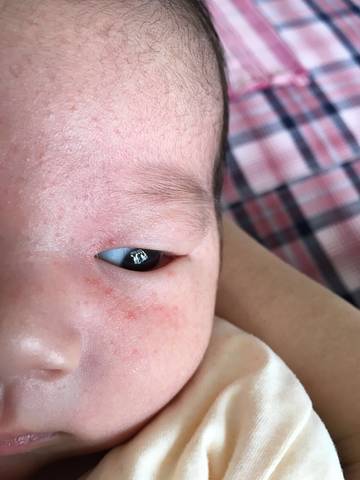 宝宝24天了,脸上出现小米粒的疙瘩,会是湿疹吗