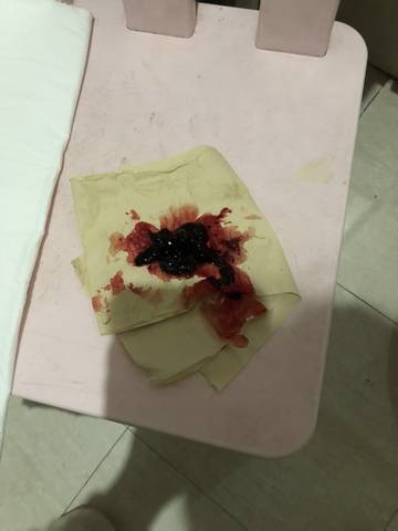 产后第六天上厕所我掉了一大块血块?还是子宫