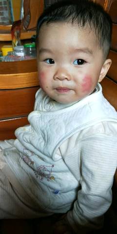宝宝脸上长红斑,不知道是什么皮肤病,大家请帮