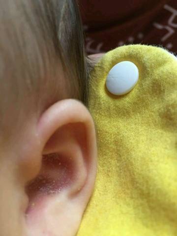 宝宝耳廓起了很多皮怎么回事?中耳炎吗?还有点黄!