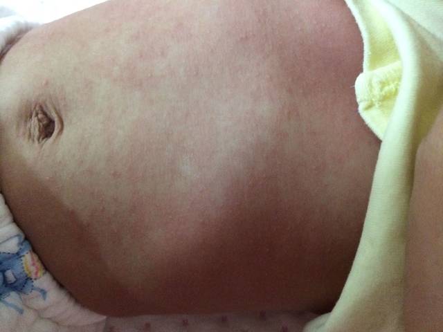 5个多月的宝宝会出麻疹吗?一般多久能退?