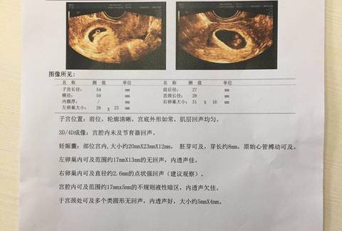 育儿问答 怀孕期 孕囊看男女,准吗?