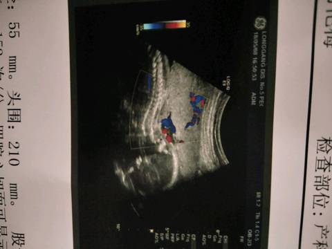 怀孕22周3天,然后胎心,胎动都正常,就是血压偏
