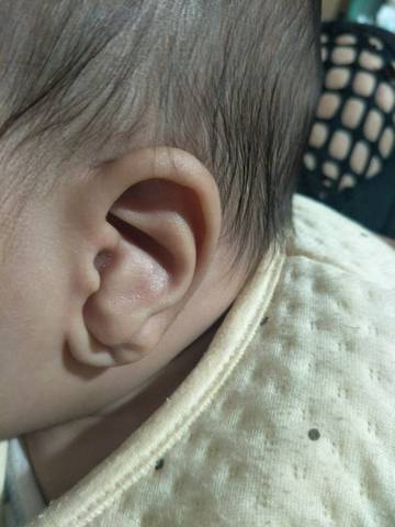 我家宝宝耳朵这种畸形,多久治疗最佳,宝宝四个