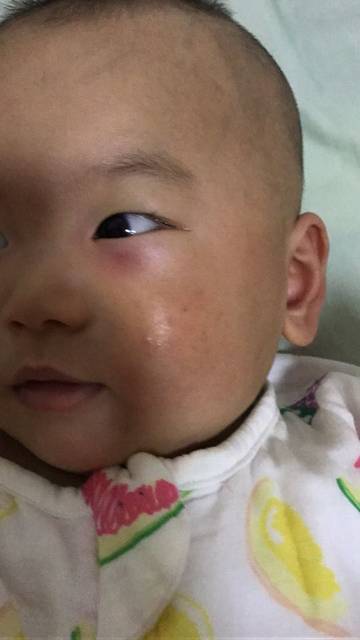 八个月宝宝下眼皮突然肿了