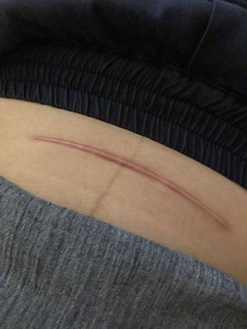 都七个月了、今天才知道这是伤口增生了。我该