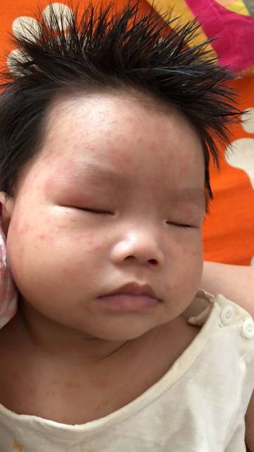 宝宝发烧38.2℃,现在身上起疹子,是小儿急诊吗
