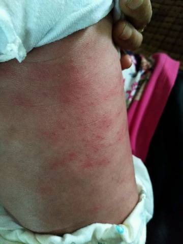二十多天的婴儿,背上长了很多疹子,是过敏还是湿疹,一直扭来扭去的不
