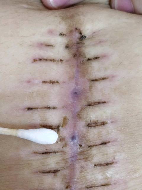 剖腹产后6天伤口脂纺漏油,20天后有淤紫正常吗