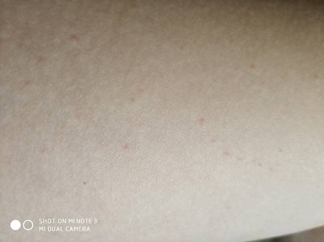 身上突然长了好多红点有点痒!