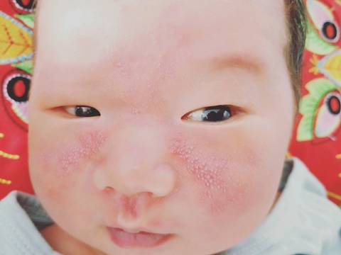 宝宝出生一周,脸上泛红,起一大片带白点点的痘