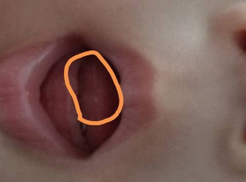 宝宝舌尖下面有条白线是什么?我圈出来的地方
