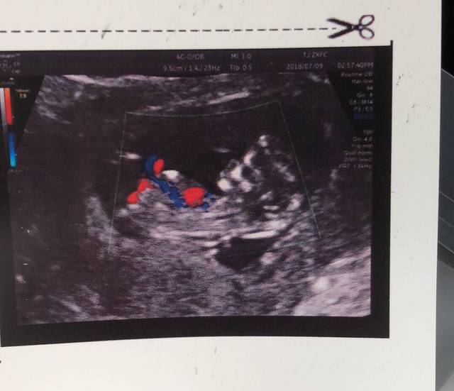 NT顺利,求科普B超照里的红线蓝线是什么意思