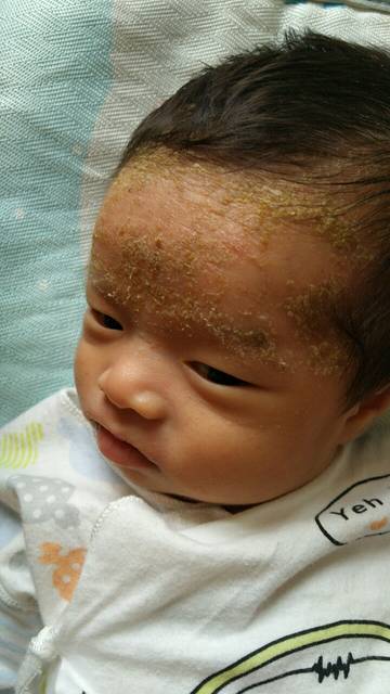 【新手报到】脂溢性湿疹 有图慎入!