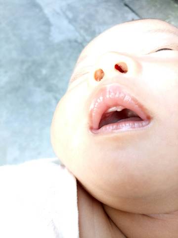 宝宝口腔里喉咙处长的白色东西是什么?