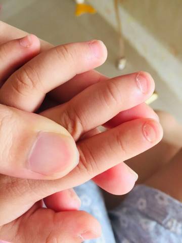 宝宝30个月,最近发现指甲盖断层,牙齿也长得不
