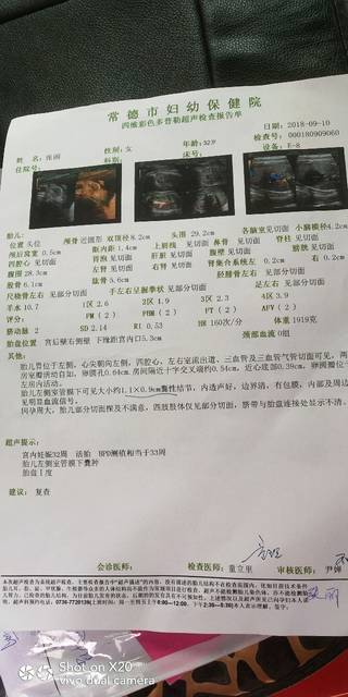 姐妹们谁懂胎儿左侧室管膜下囊肿的进来交流一