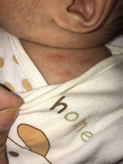 各位宝妈帮忙看下宝宝身上起的红疙瘩上边还有