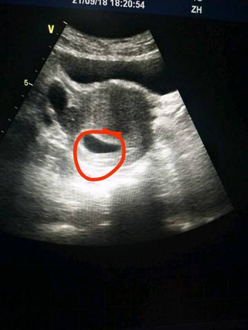 育儿问答 怀孕期 46天彩超有胎芽没胎心,谁能从孕囊看出来男女  当时