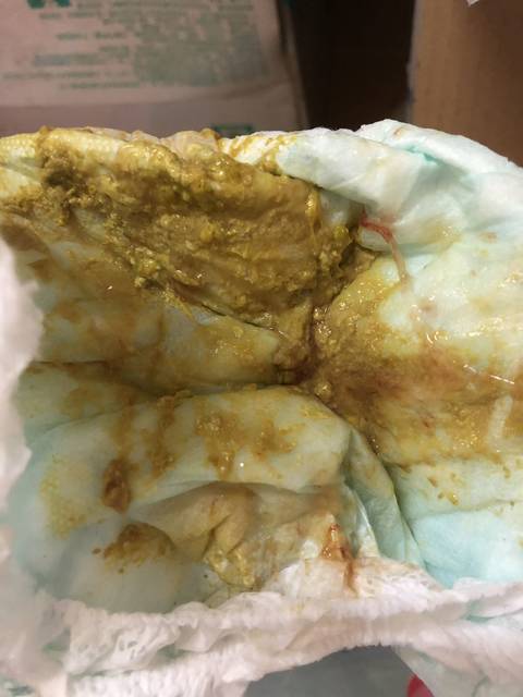 一岁半宝宝拉肚子伴有低烧怎么回事