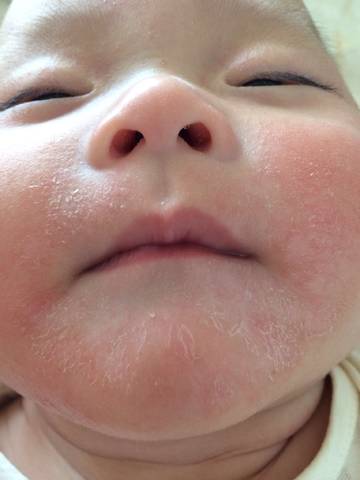 各位宝妈问一下宝宝牛奶过敏脸上红红的脱皮很