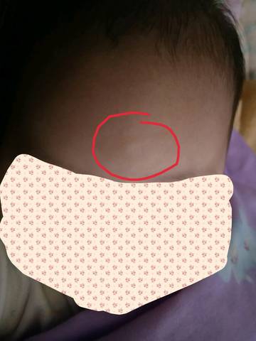 宝宝3个月,两周前开始,脸上有个圆的小白斑,近