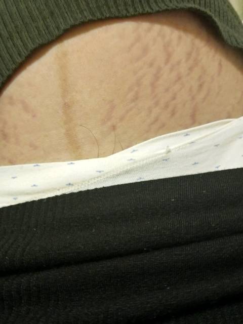 孕妇孕辰纹怎么去