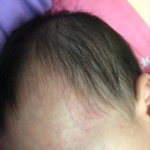 六个月宝宝出疹子,这是幼儿急疹吗?没有发烧,