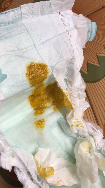 宝宝拉肚子怎么办