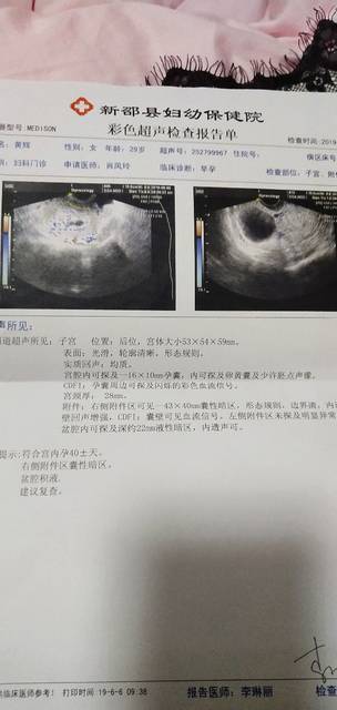 42天了今天去B超检查还没有胎心胎芽 急死我了